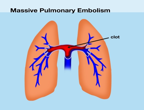 Prevention of Pulmonary Embolism