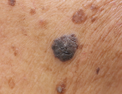 Skin Cancer and Medical Negligence