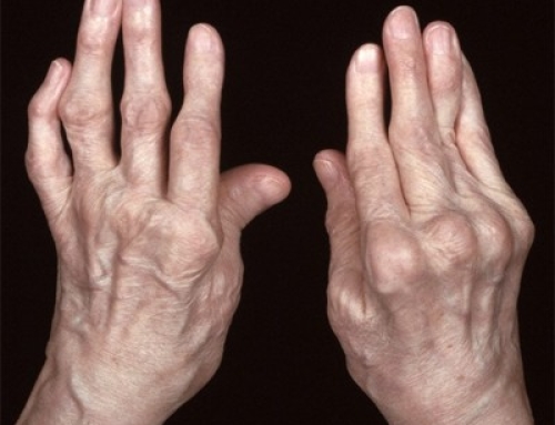 What is Rheumatoid Arthritis and is it Treatable?