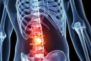 Paralysis after spine surgery lawyer Cleveland OH