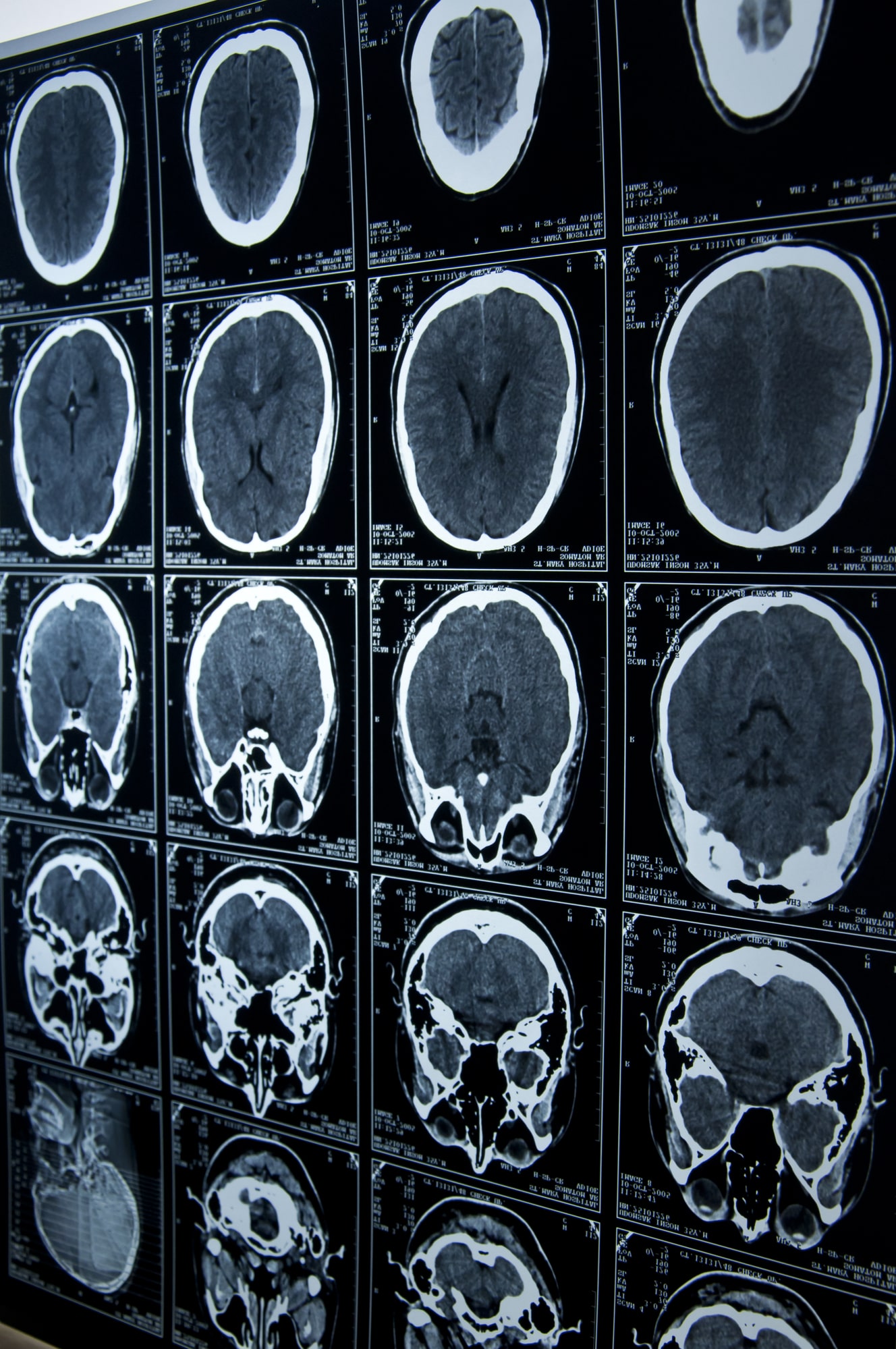 Brain Injury & Stroke - Ohio Medical Malpractice Attorneys