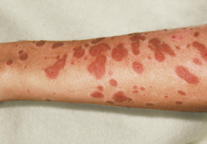 Cleveland Stevens-Johnson Syndrome Lawyer