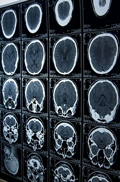 Brain Injuries and Stroke