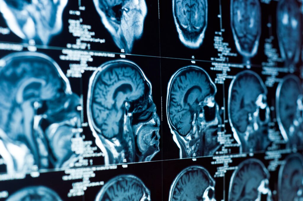 brain injury lawyer Cleveland, OH