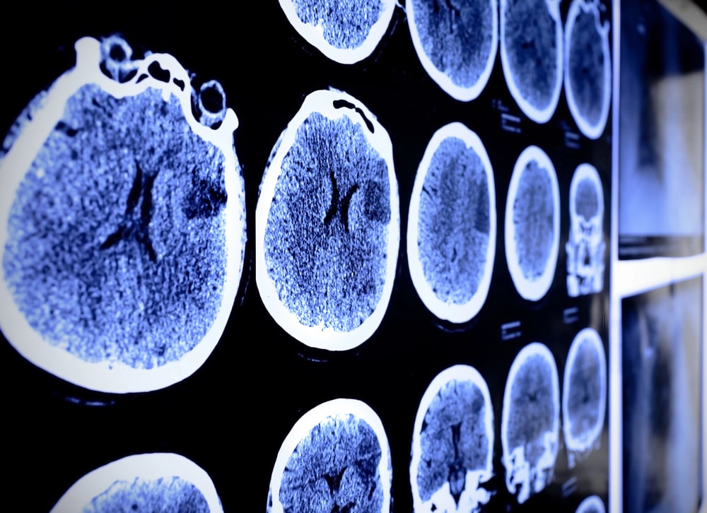 brain injury lawyer Cleveland, OH