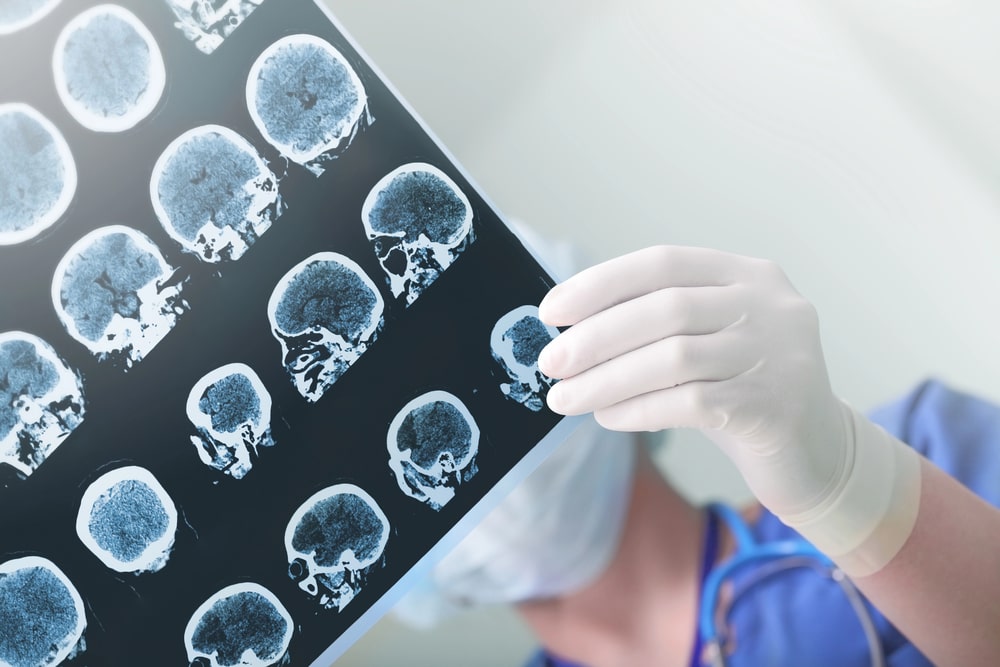 brain injury lawyer Mansfield OH