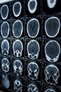 brain injury lawyer in Mansfield OH